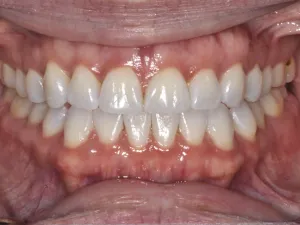 A photo of Case 307 Retracted After