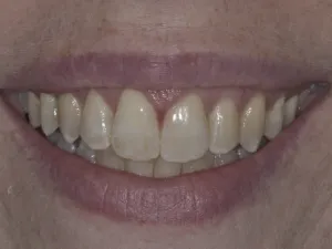 case 308 smile after photo