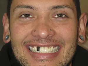 case 601 full face after photo