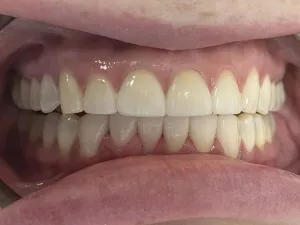 Case 700 Retracted After photo