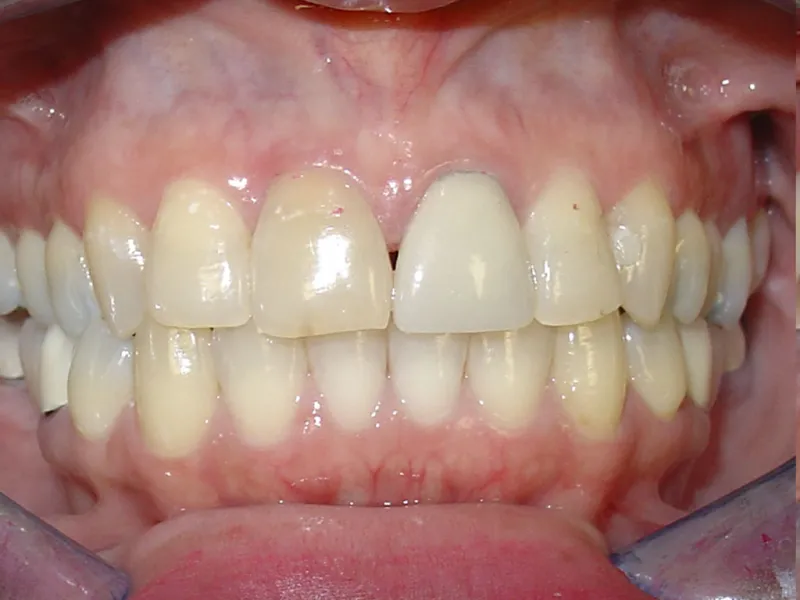 case 003 retracted before photo