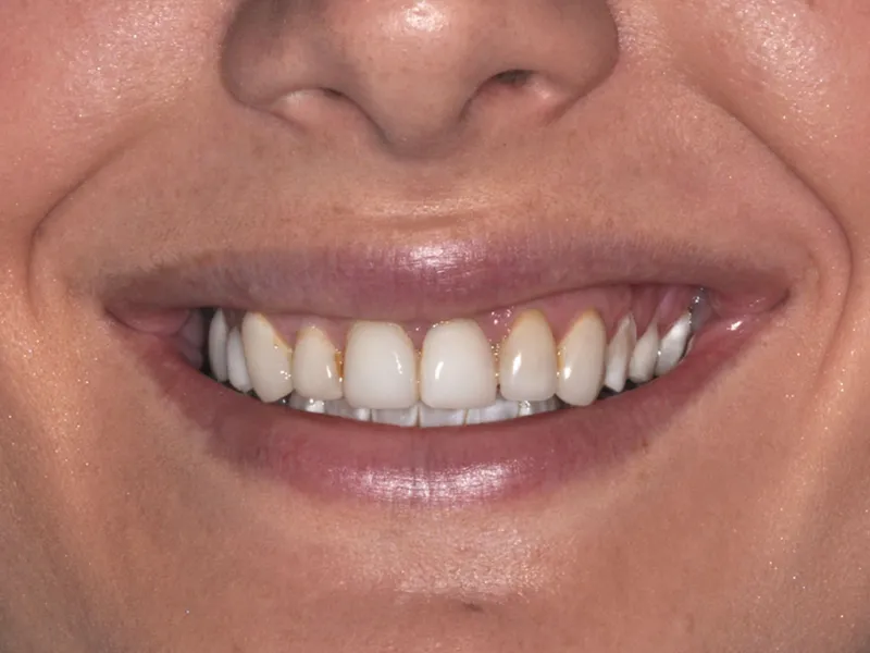 case 007 smile before photo