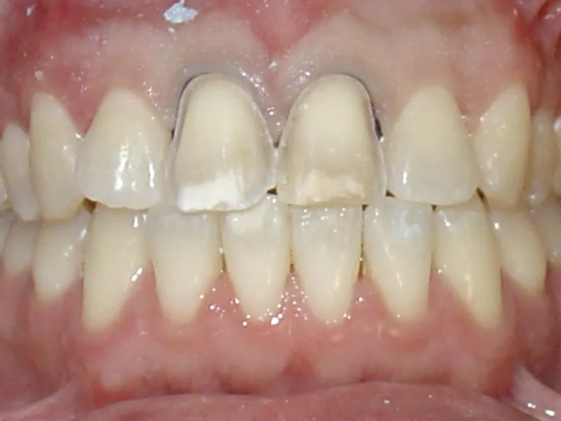 case 009 retracted before photo