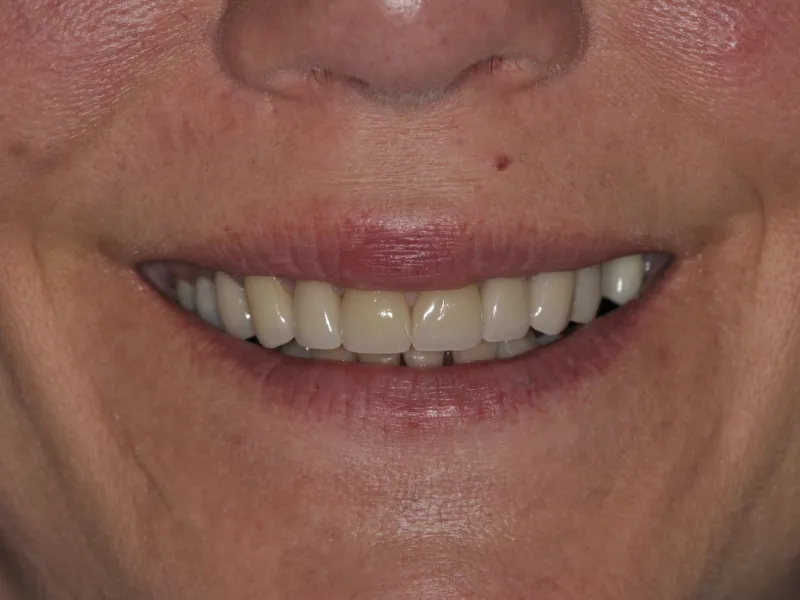 Case 0106 smile after photo