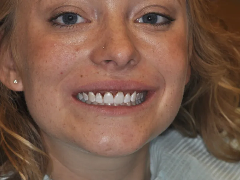 case 016 full face before photo