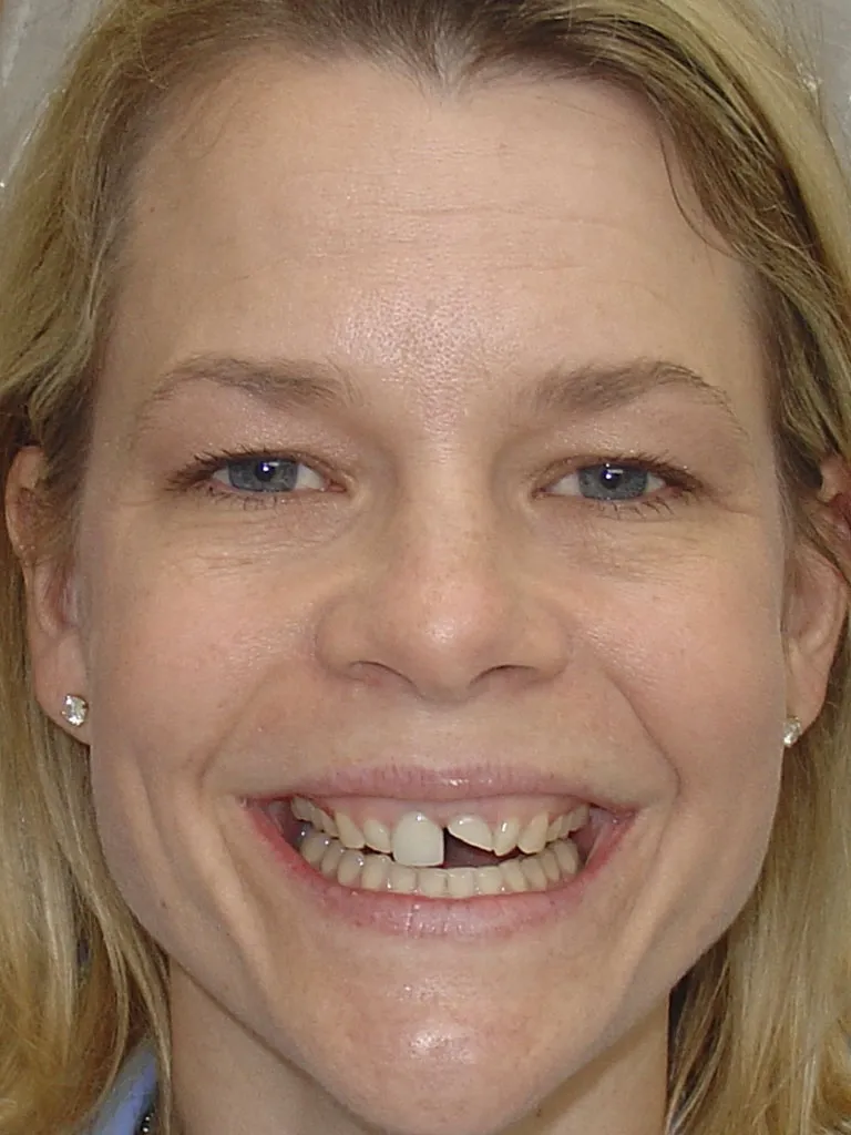 case 019 full face before photo