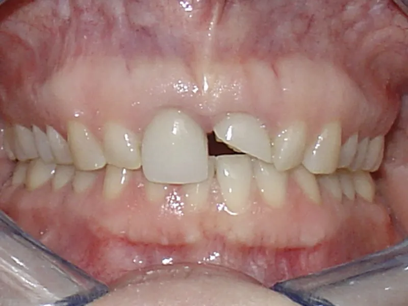 case 019 retracted before photo