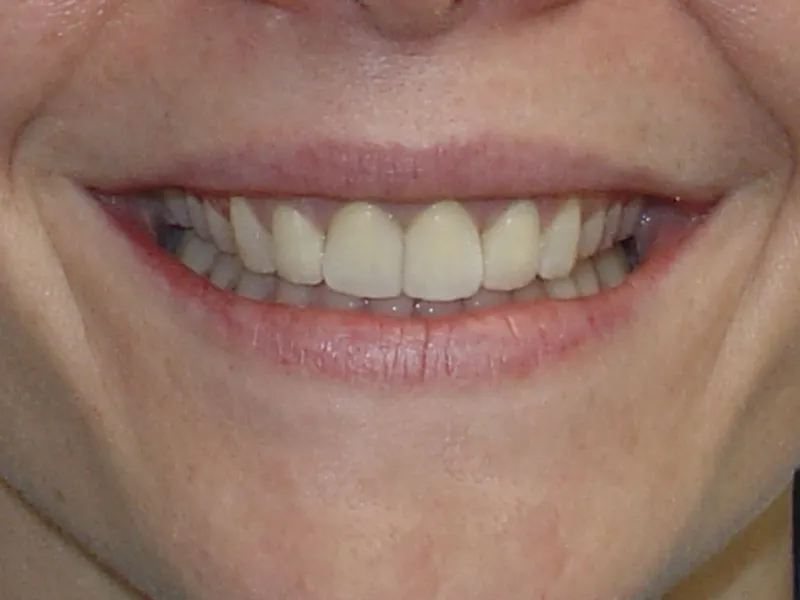 case 019 smile after photo