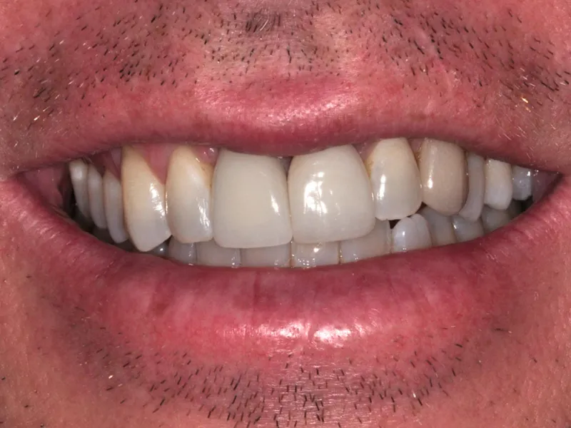 case 020 smile after photo 