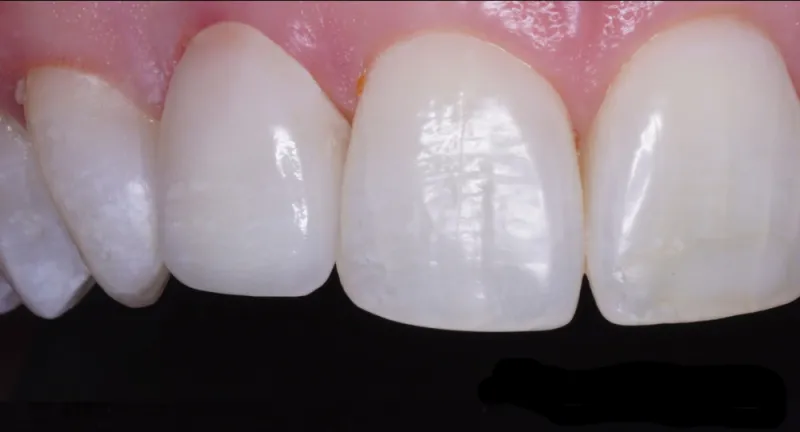 A row of top teeth