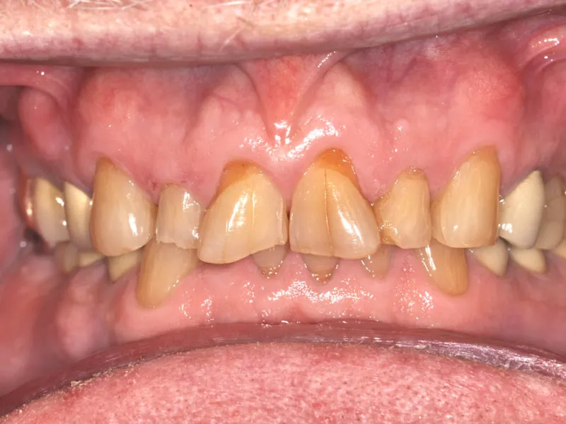 case 022 retracted before photo