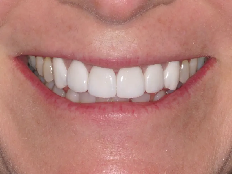 case 044 smile after photo