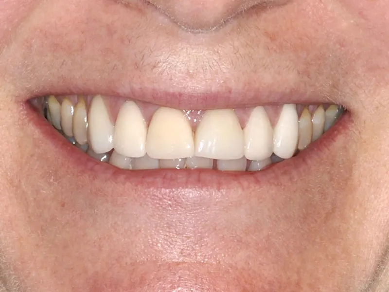 case 044 smile before photo