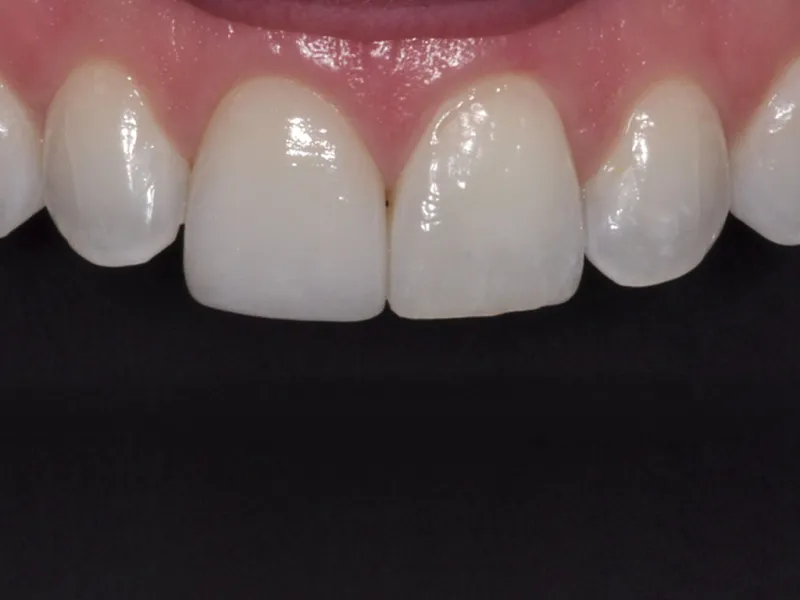 Case 048 close up after photo