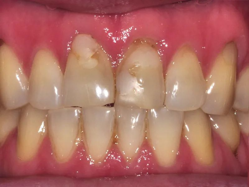 case 070 retracted before photo