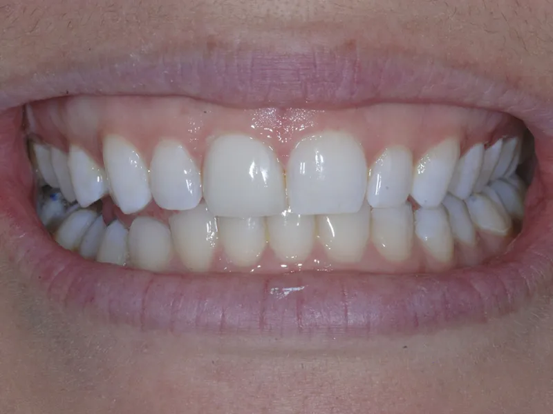 case 075 smile after photo