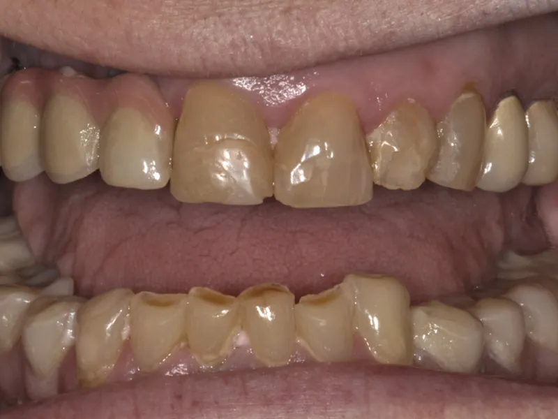 case 081 retracted before photo