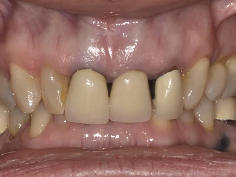 case 083 retracted before photo