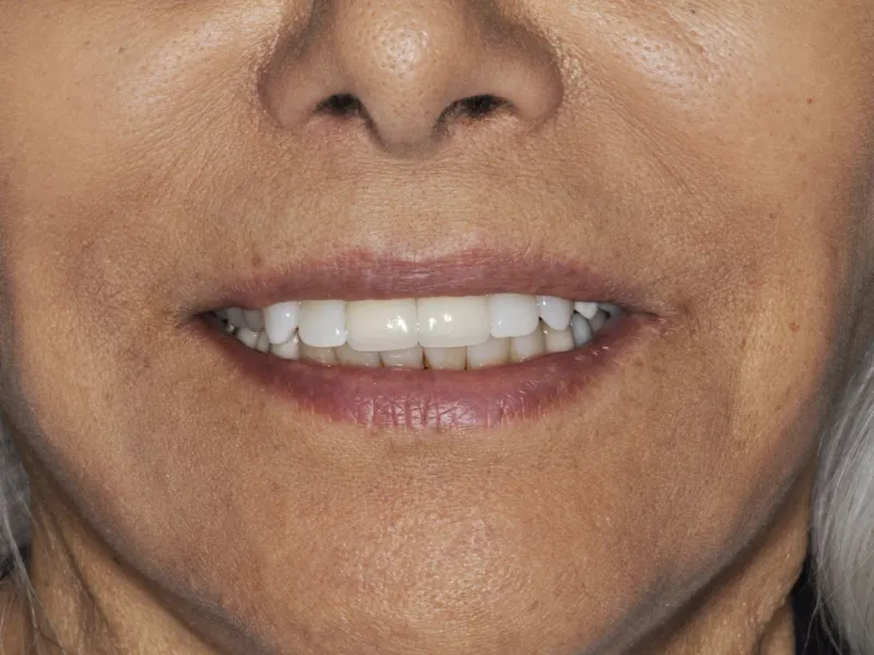 A photo of case 303 smile after