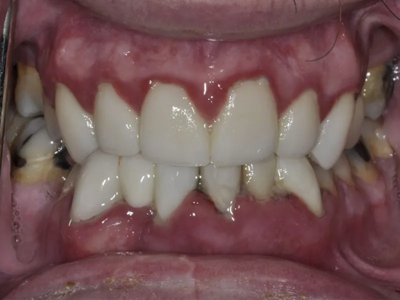 case 304 retracted before photo