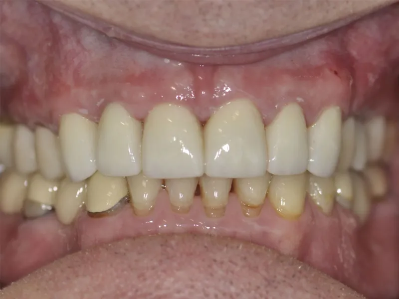 case 305 retracted after photo