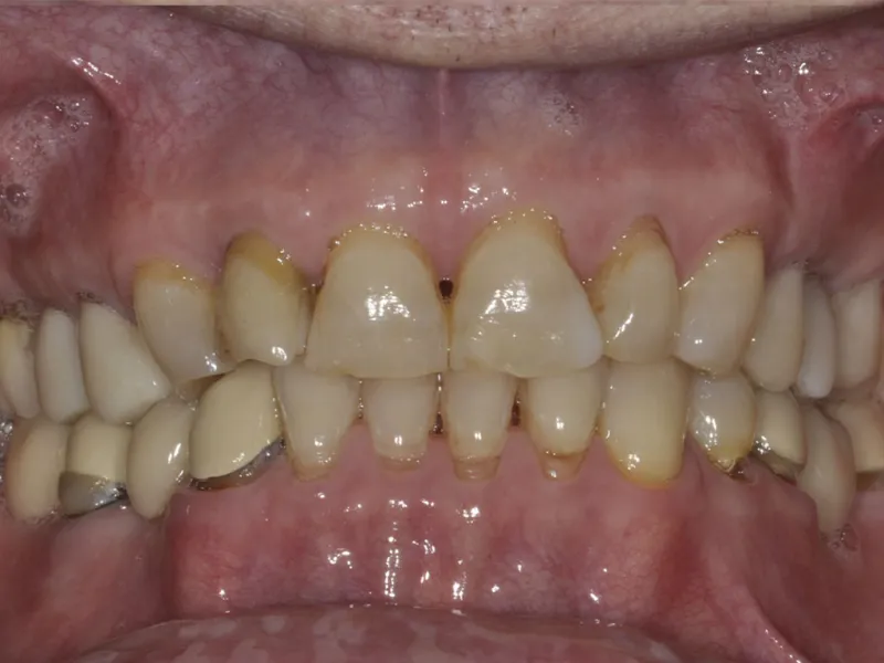 case 305 retracted before photo