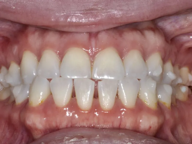 case 307 retracted before photo