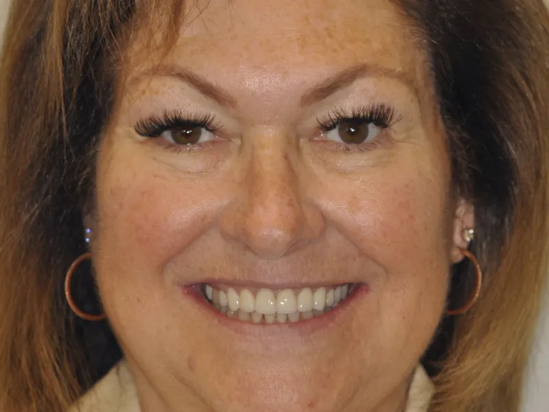 Full face smiling after photo of corrected dental wear.