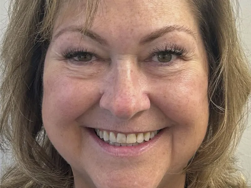 Full face smiling before photo of dental wear.