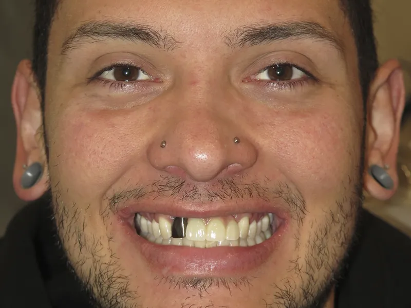 Case 601 Full Face after photo