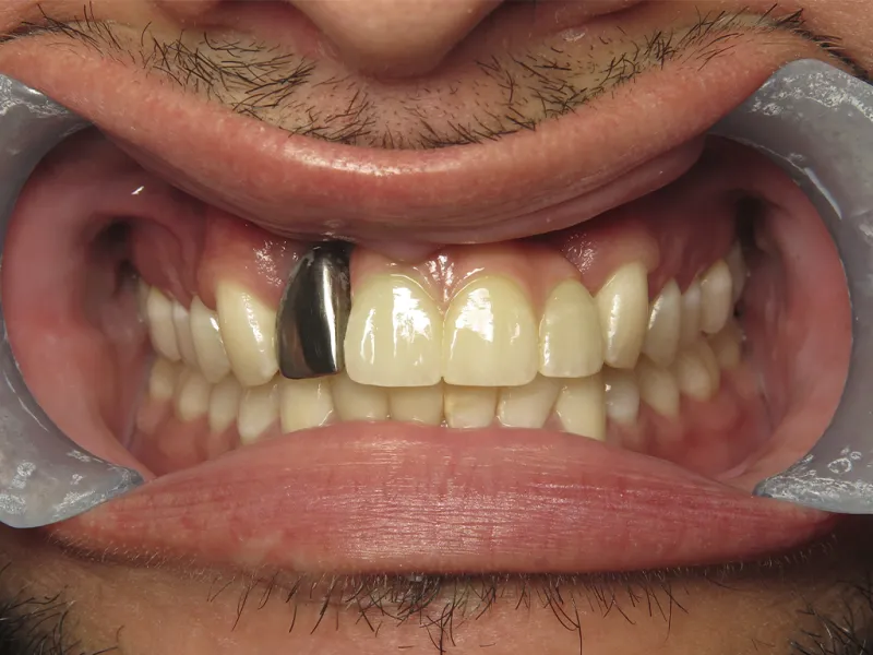 Case 601 Retracted after photo