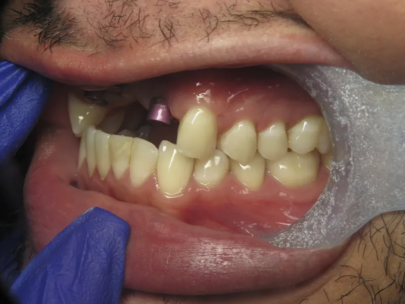 Case 601 Side Before photo