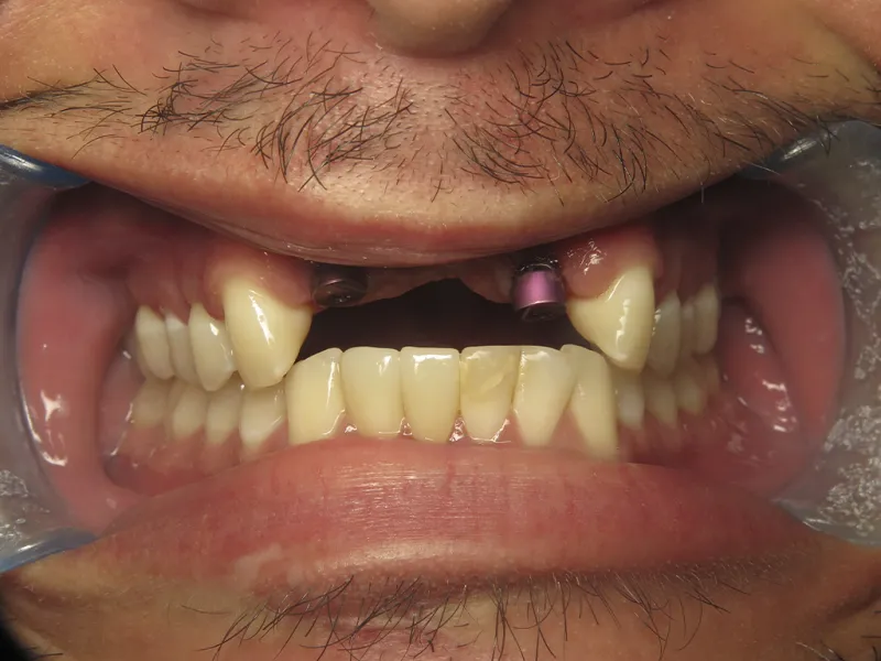 Case 601 Retracted Before photo