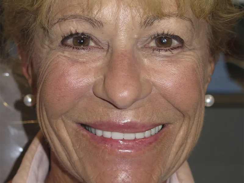 Full face after photo of Cheryl