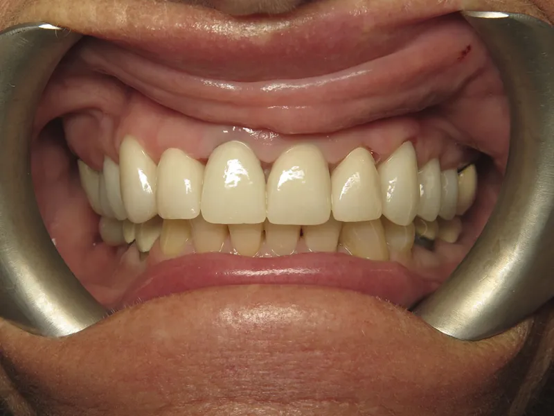 Retracted view of Cheryl's smile after restoration.