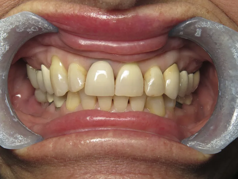 Retracted view of Cheryl's smile before restoration.