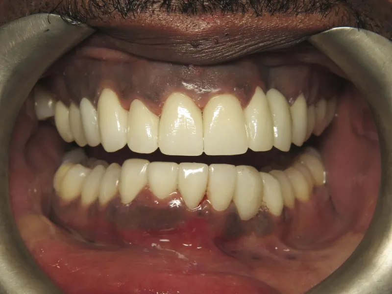 Picture of case 603 smile after