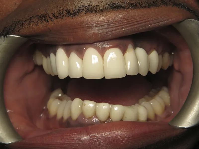 A close-up before photo of Colton's smile with lips retracted.