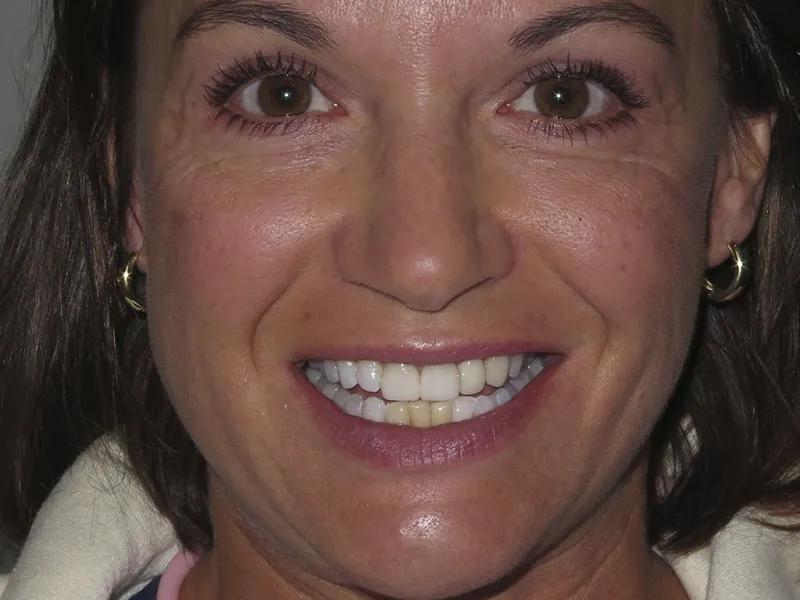Full face before photo of Tara's smile.