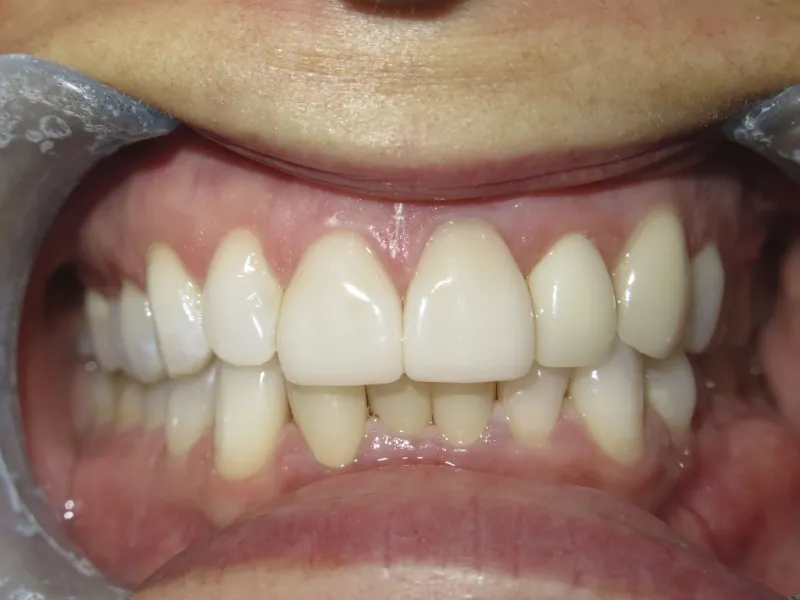 Retracted after view of Tara's smile.