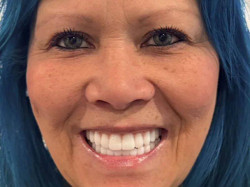 Case 605 after smile