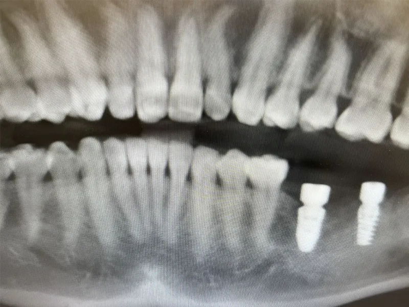 case 700 X-ray after photo