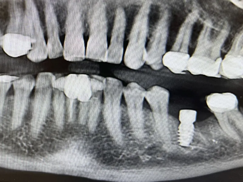 case 700 X-ray before photo