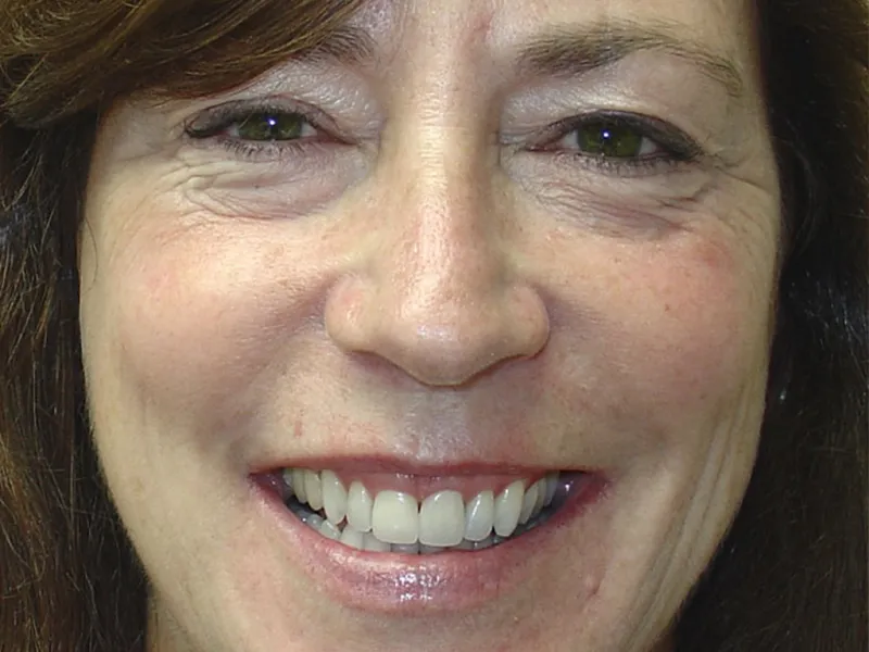 case 060 full face after photo
