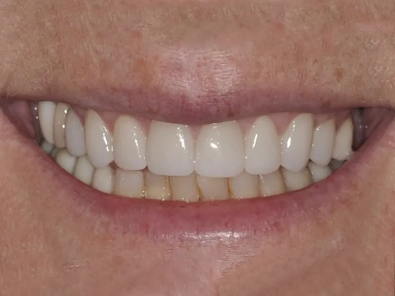 irresistible smile refinement photo
