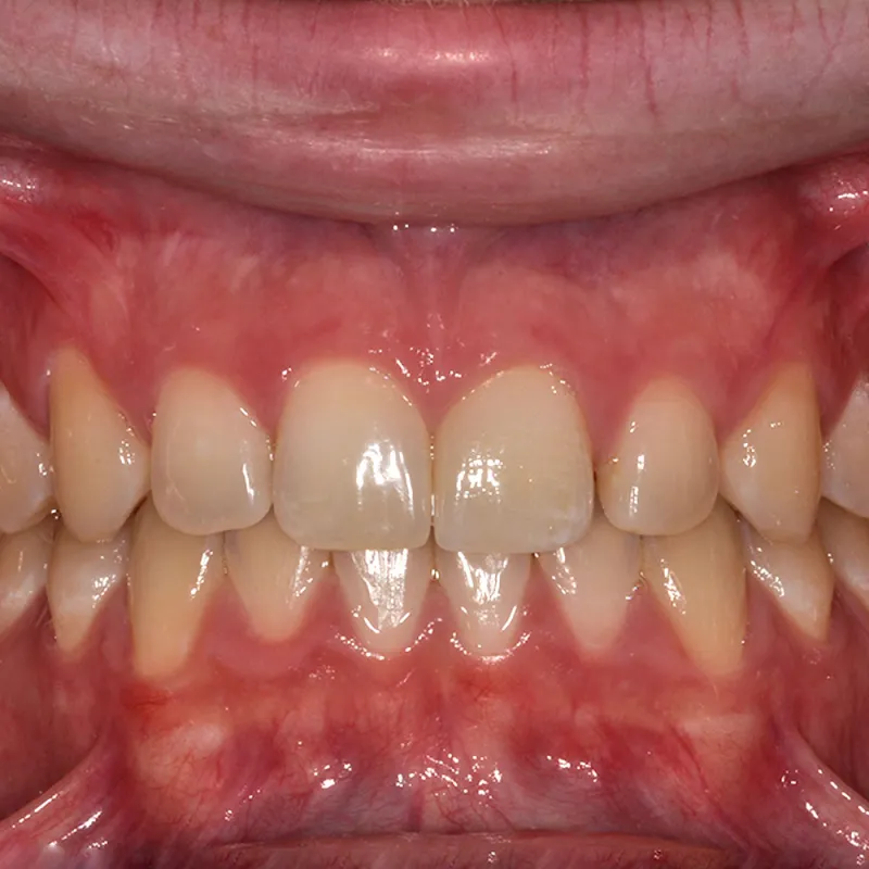 After A Perfectly Matched Chip Repair
