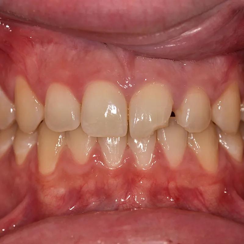 Before A Perfectly Matched Chip Repair