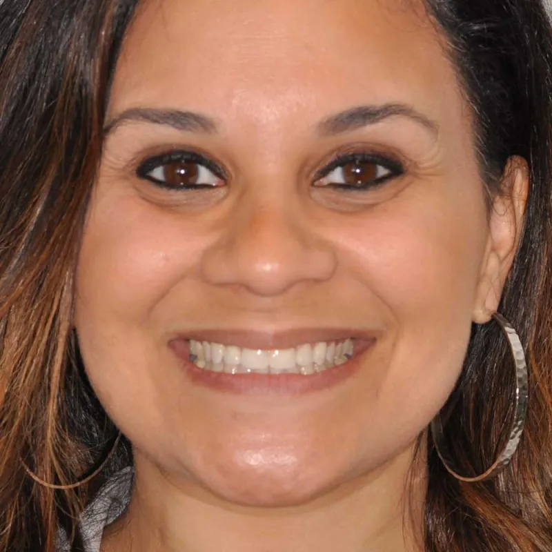 After a restoration of a smile